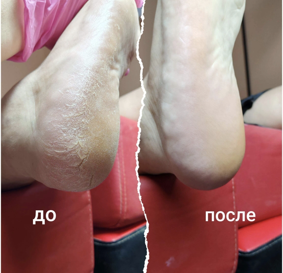 Медицинский педикюр (гиперкератоз) без покрытия
